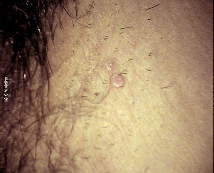 Mollusco contagioso