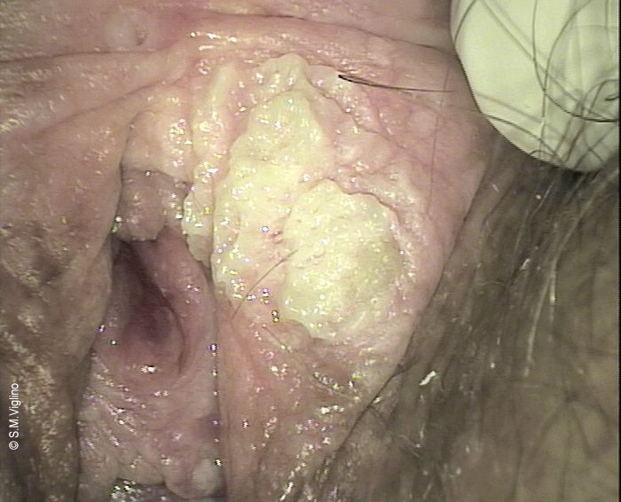 Lesione vulvare verrucoide